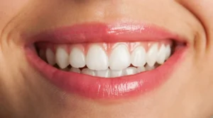 Close-up smile after composite bonding treatment.
