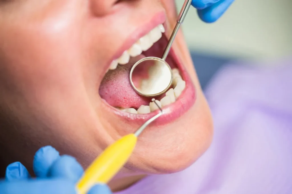Close-up of a dental check-up using a mouth mirror and examination tools.