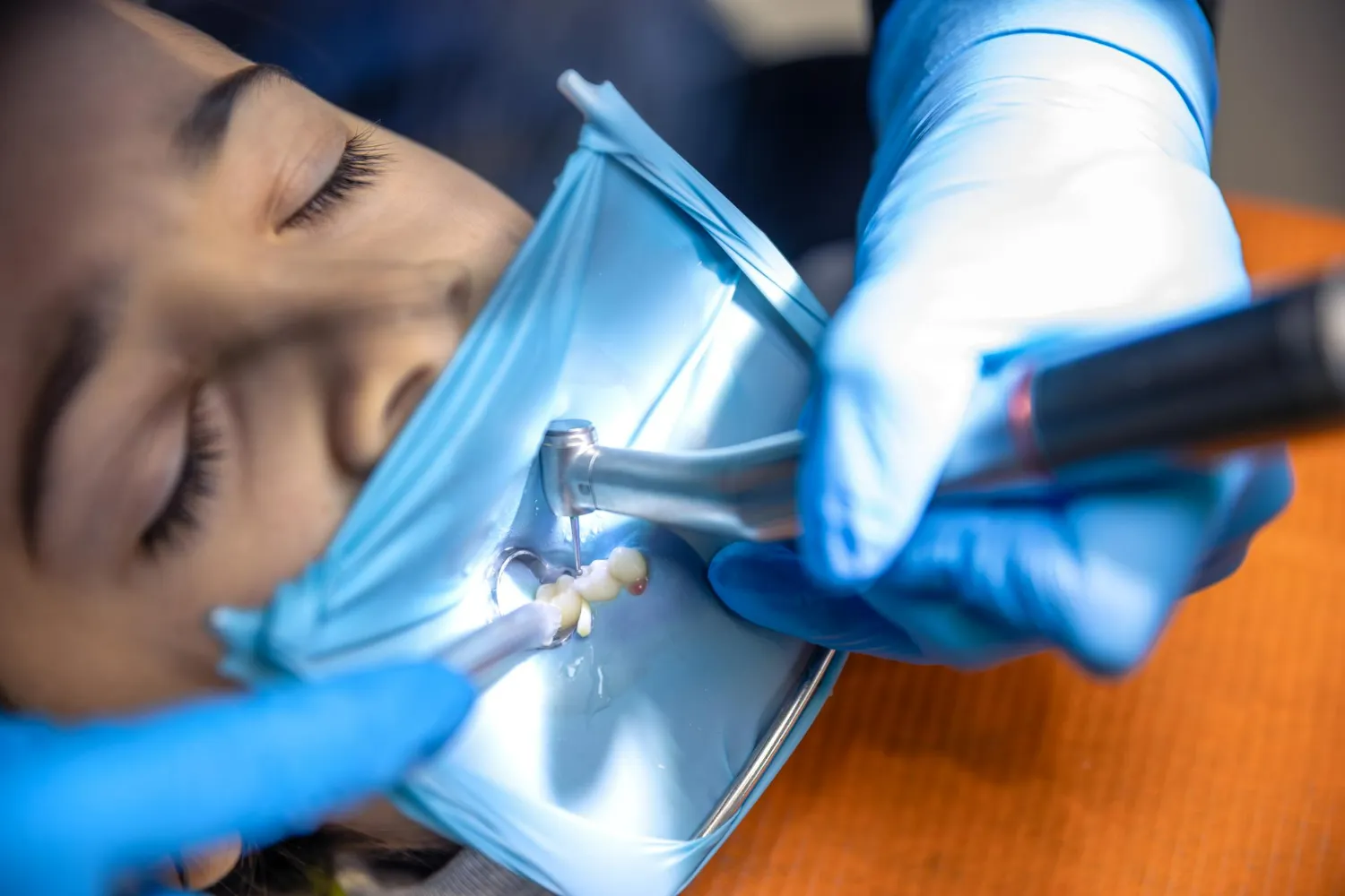 Close-up of a tooth filling procedure with dental instruments and isolation in place.