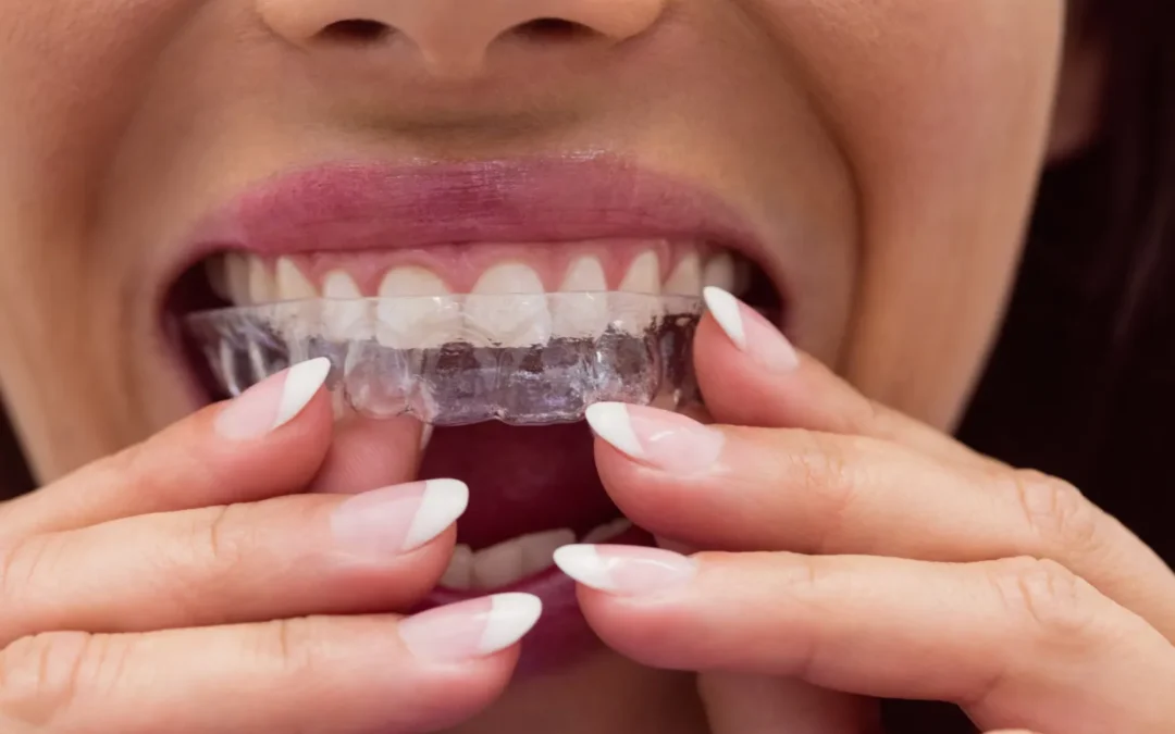 Can Invisalign Fix an Overbite? A Clear Guide to Treatment