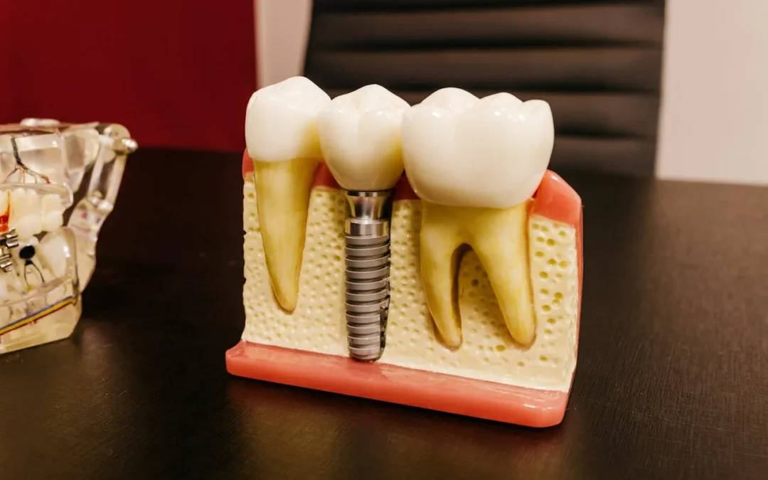 Are dental implants painful? What to expect before and after surgery