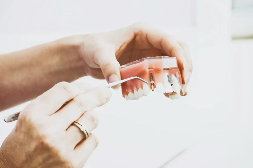 Close-up model showing how a dental implant is placed into the gum and jawbone.