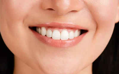 Is Teeth Whitening Safe? What to Know Before Treatment