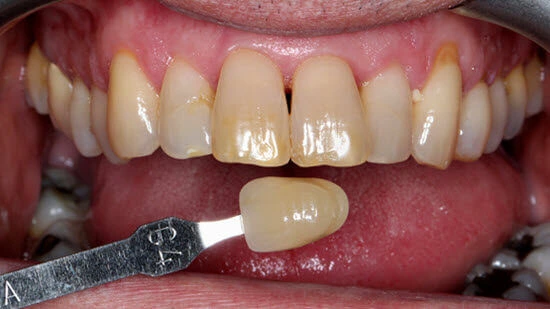 Discoloured teeth before whitening treatment at Muse Dental