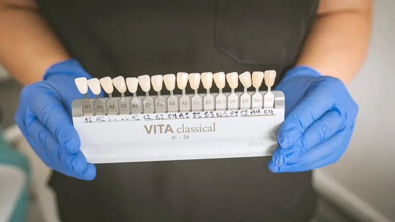 What Stains the Teeth Most After Whitening?