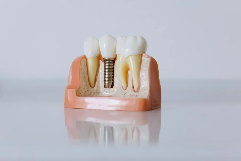 Dental implant model showing an implant positioned within the jawbone.
