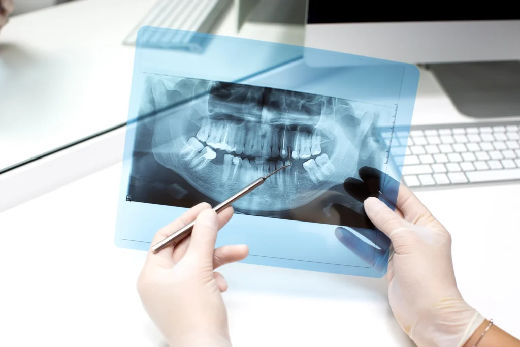 Dental professional examining a panoramic X-ray during implant assessment.